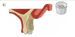 Implantologie: Knochenaufbauten - Abb. 04