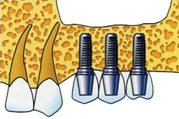 3 Schraubimplantate mit Zahnersatz bestckt